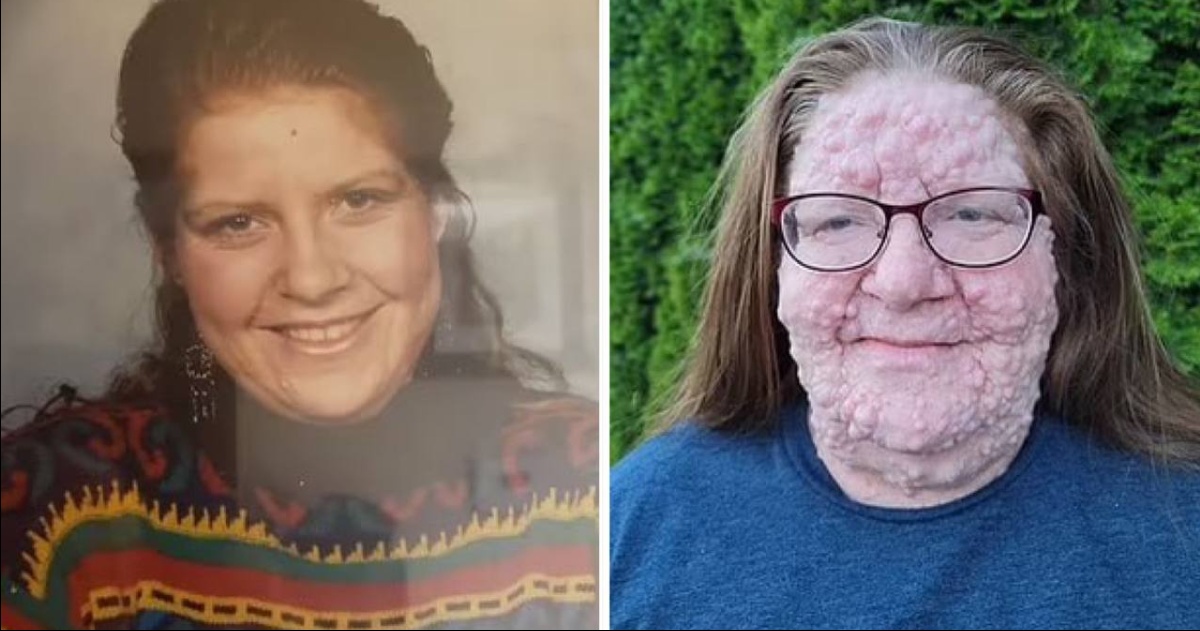 Mercedes Christensen: Living with Neurofibromatosis - A Rare Genetic